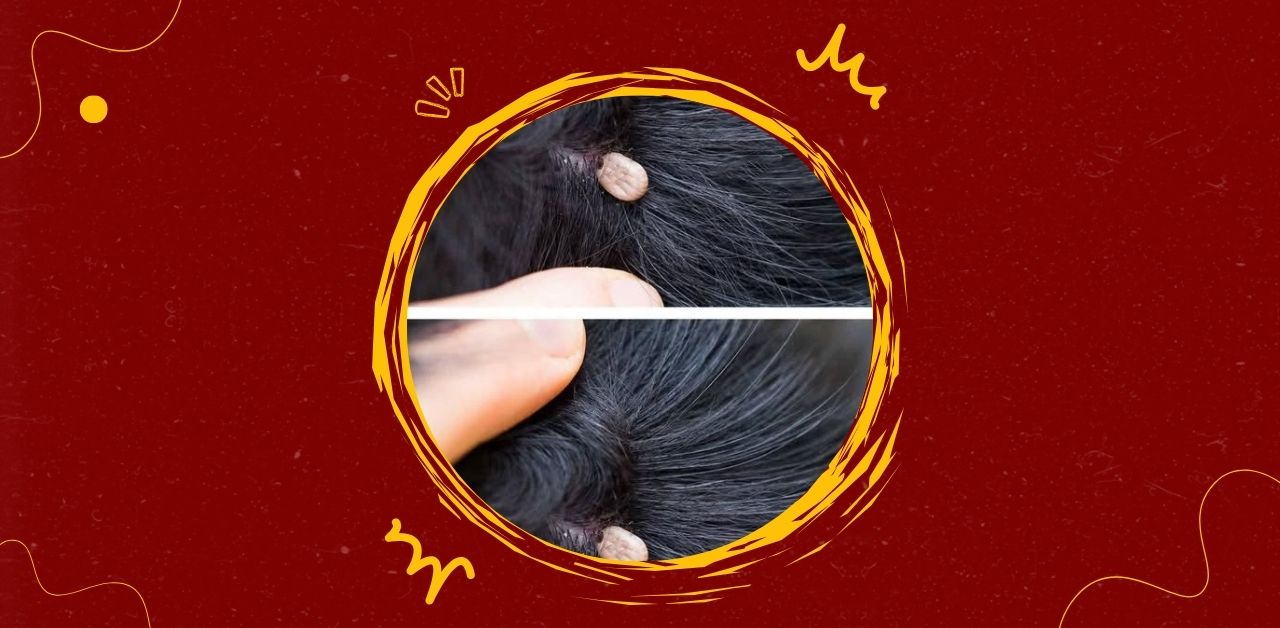 Understanding Ticks in Human Hair